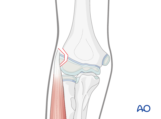 timing of treatment of fractures of the distal humerus