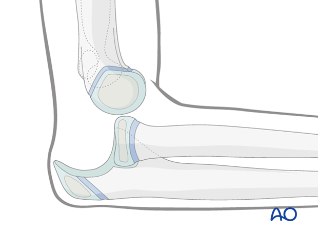 timing of treatment of fractures of the distal humerus