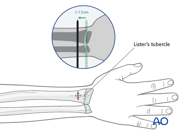 ESIN - Dorsal (Lister’s tubercle) entry point to the radius