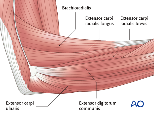 Lateral approach - Identifying intervals