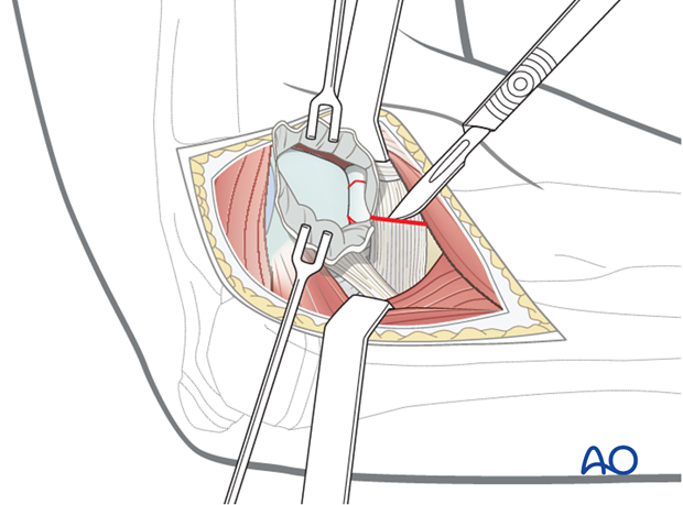 Lateral approach - Deep surgical dissection