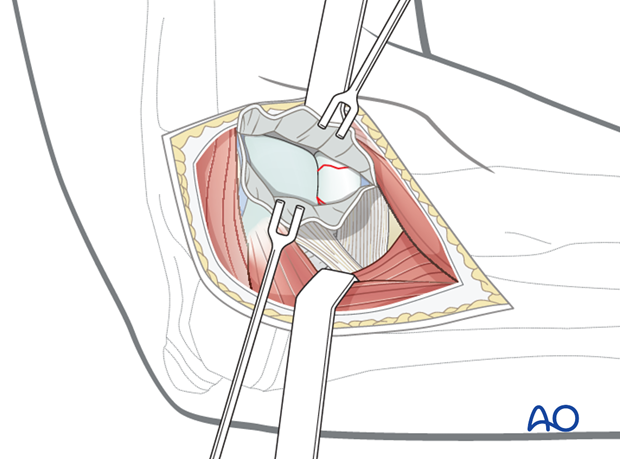 Lateral approach - Release of proximal capsule and muscle