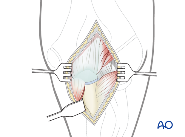 Posterior approach - Dissection