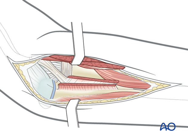 Posterolateral approach - Exposure of radial head/neck