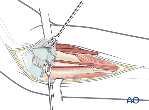 Posterolateral approach - Exposure of radial head/neck