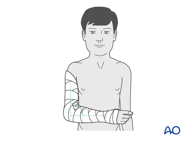 Splint immobilization for Ulna, avulsion of apophysis