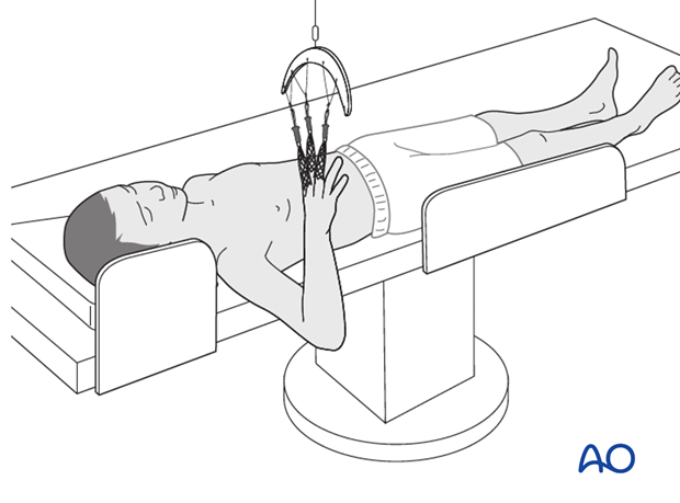 Supine position for casting