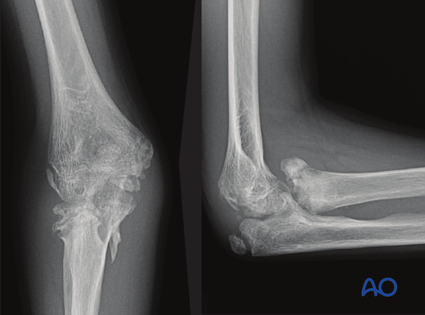 complications of radial head and neck fractures