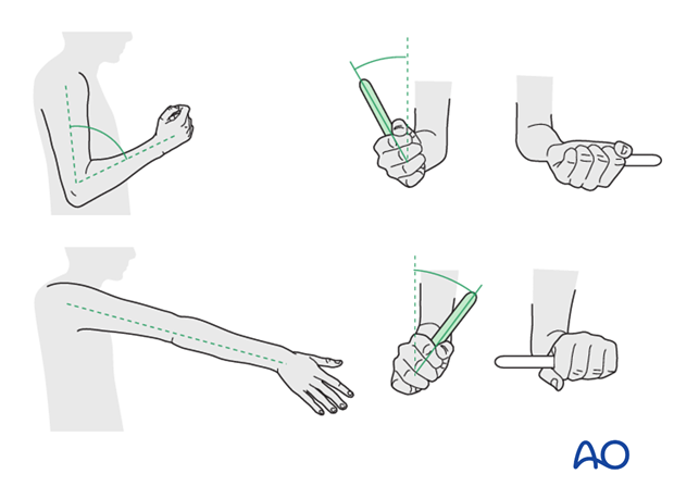 complications of radial head and neck fractures