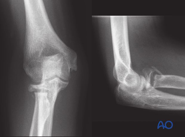 complications of radial head and neck fractures