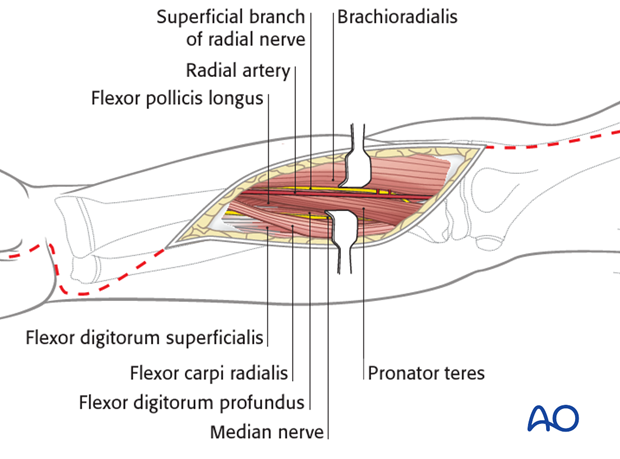 compartment syndrome