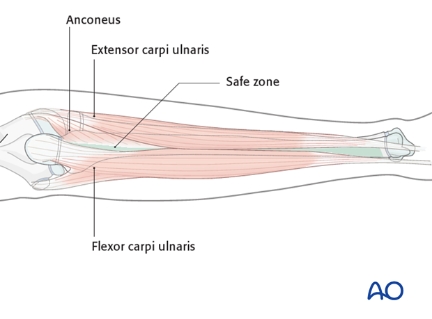 Safe zones in the ulna