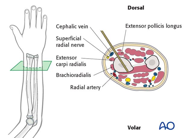 This cross-section illustrates the distal 1/3 of the forearm.