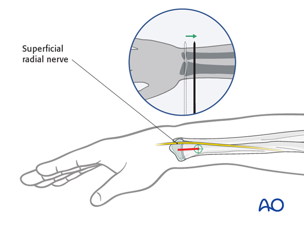 ESIN entry points (radius)