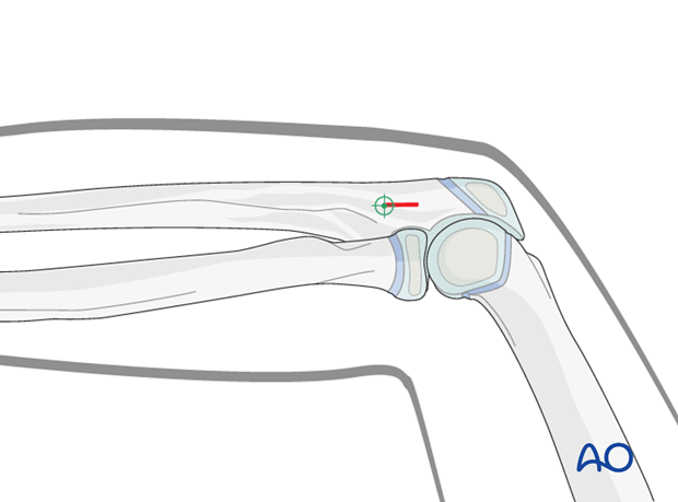 ESIN entry points (ulna)