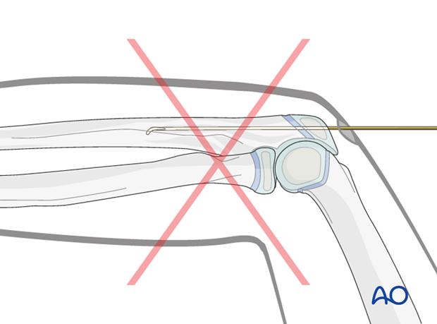 Pitfall: Entry point through the olecranon