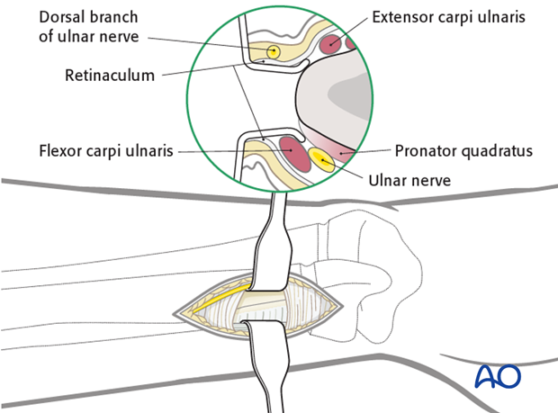 Distal medial entry point for the ulna