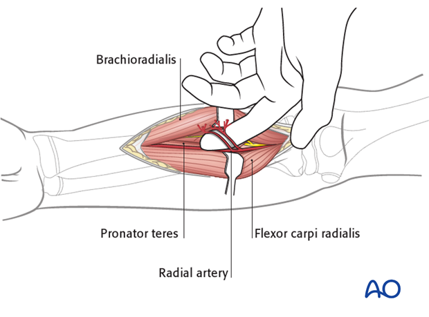 Superficial dissection