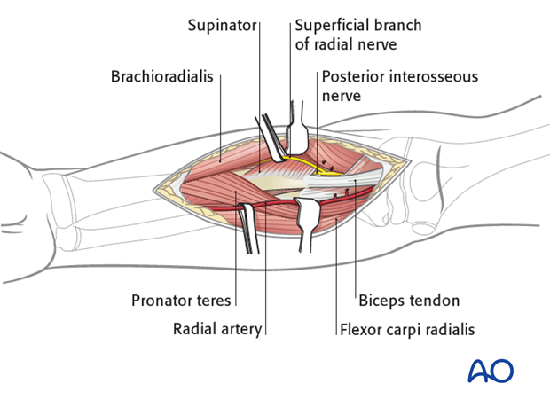 Superficial dissection