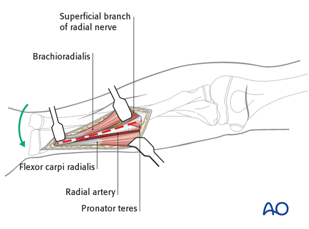 Deep dissection - distal third