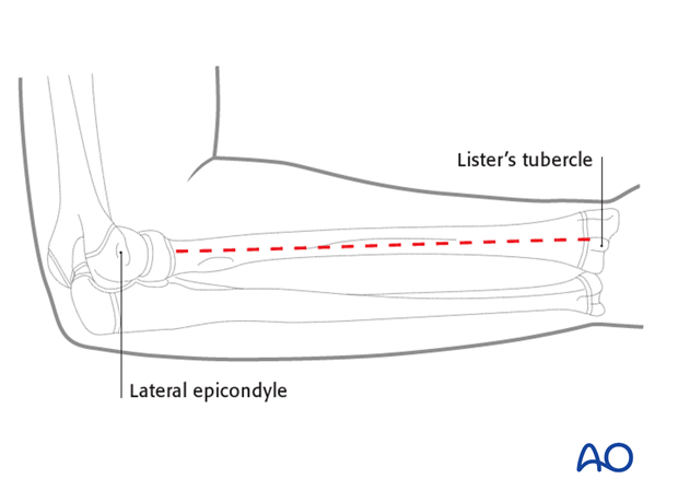 The posterolateral (Thompson) approach offers good exposure of the middle and distal thirds of the radial shaft.