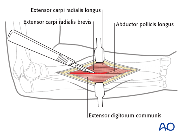 Deep dissection - middle third