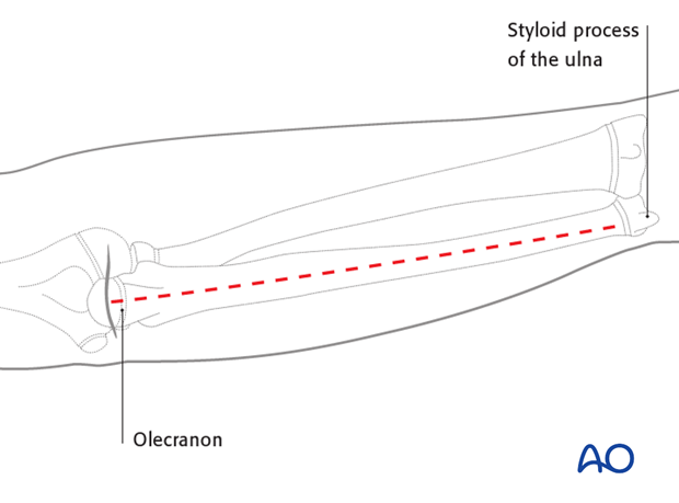 Approach to the ulna