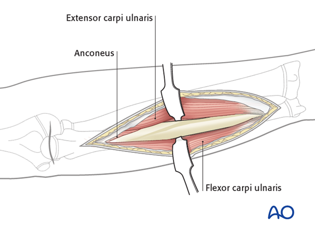 Deep dissection