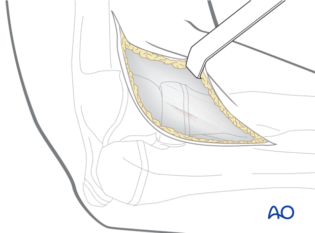 Superficial surgical dissection