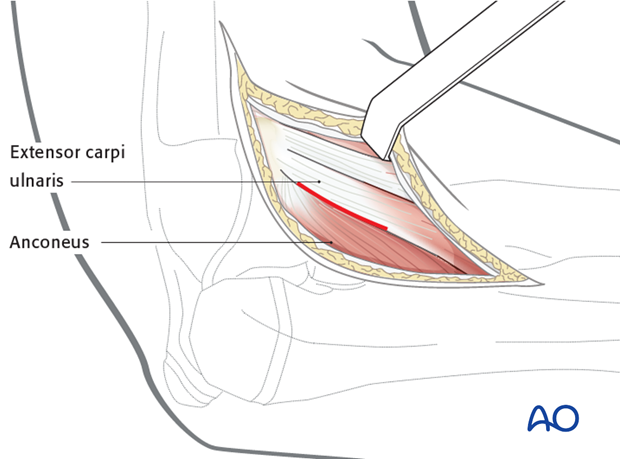 Lateral (Kocher) approach to the proximal radius