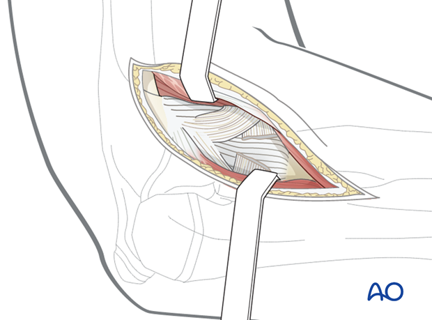 Release of proximal capsule and muscle