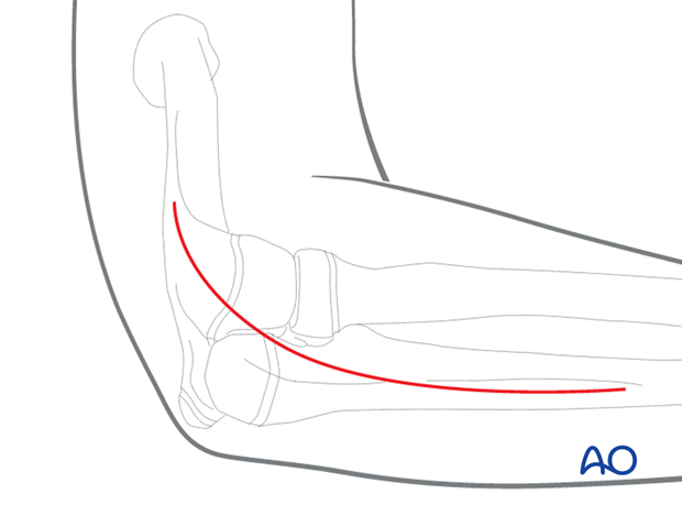 Posterolateral (Boyd) approach to the proximal radius and ulna