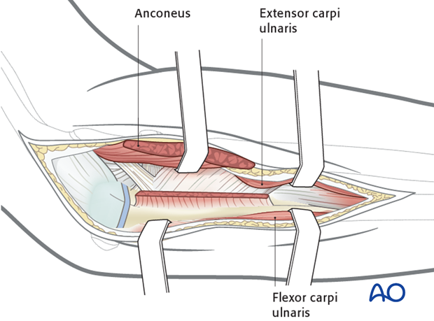 Exposure of posterior surface of the ulna