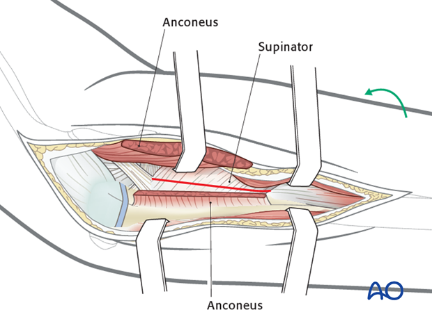 Exposure of radial head/neck