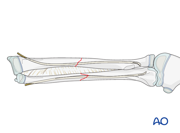 The ESIN method involves closed reduction and internal fixation with an elastic nail.