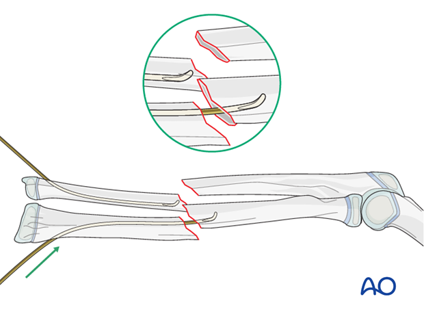 Reduction with nail