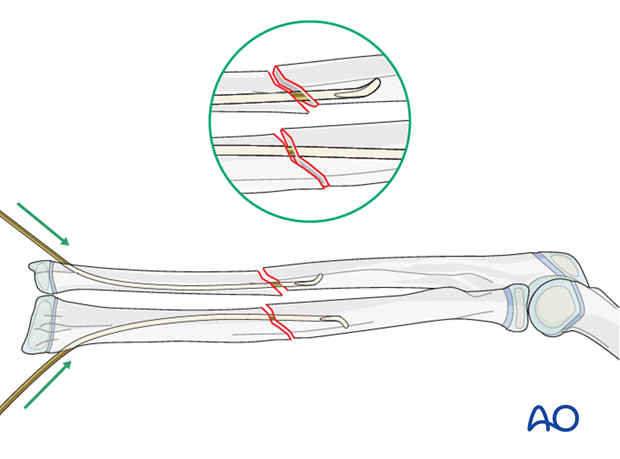 Passing the second nail