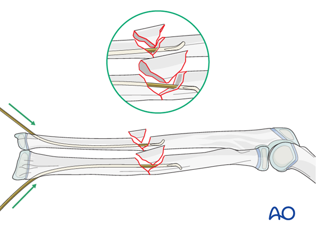 Reduction with nail