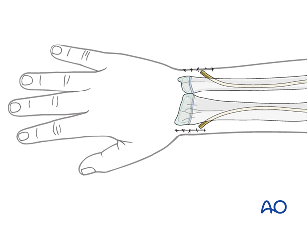 Wound closure