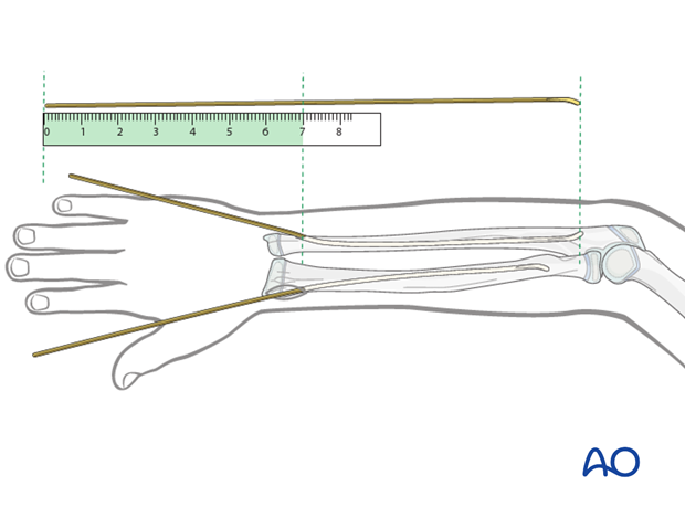 Estimate the optimum nail length with a second identical nail placed parallel to the initial nail.