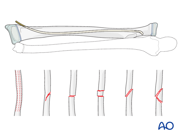 Reduction and fixation of the radius