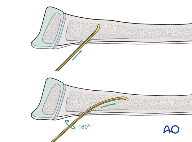 Nail insertion