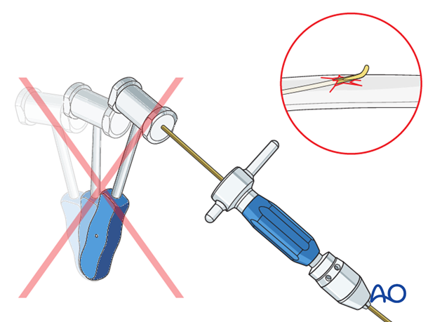 Do not use a hammer if the nail is stuck as this risks iatrogenic fracture.