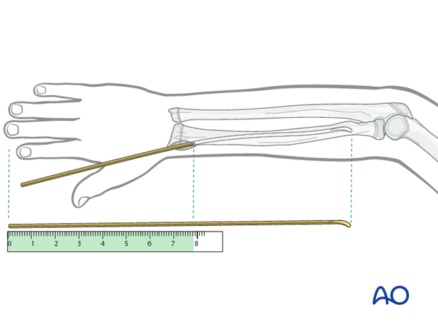 Estimate the optimum nail length with a second identical nail placed parallel to the initial nail.