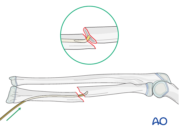 Reduction with nail