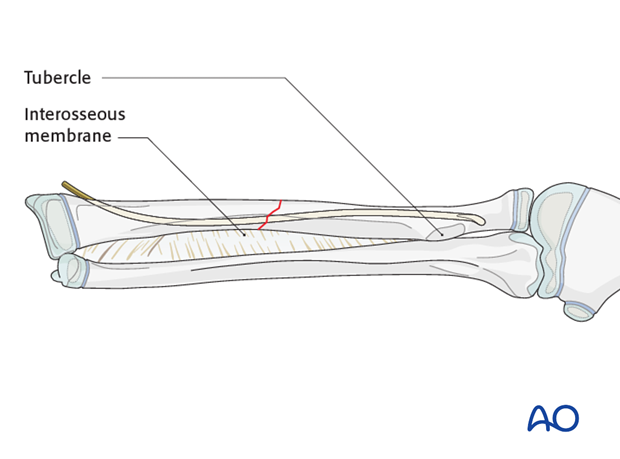 Final nail position