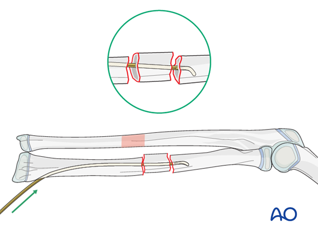 Reduction with nail