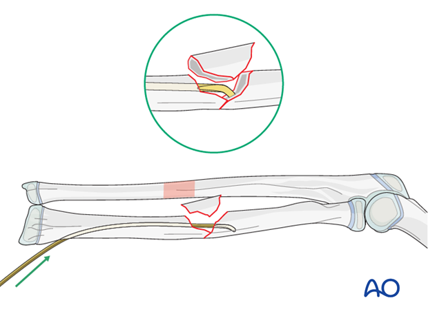 Reduction with nail