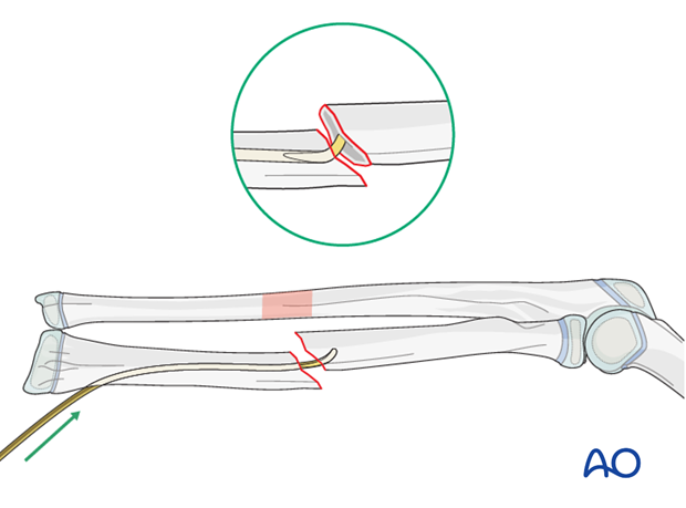 Reduction with nail