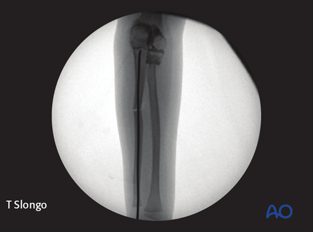 Osteotomy